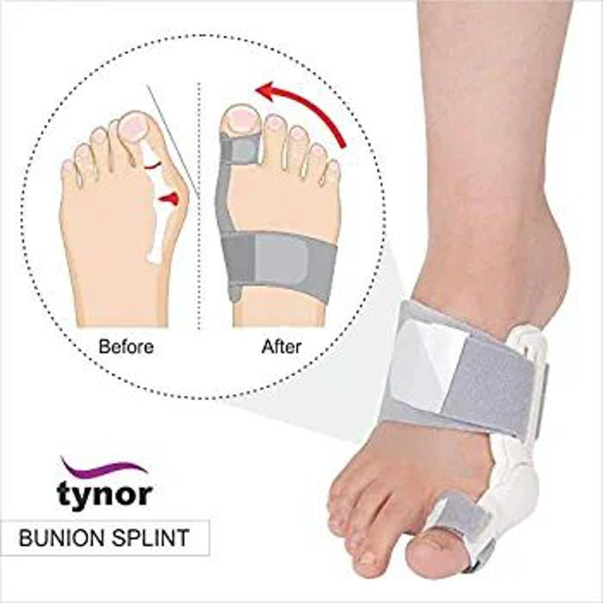 BUNION SPLINT (TYNOR)